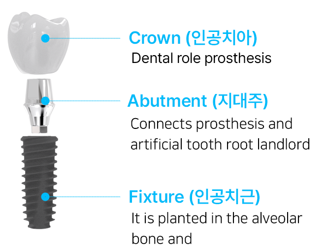 ایمپلنت کوروان CORE1 Implant (10۰۰ عددی )